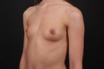 Breast Augmentation