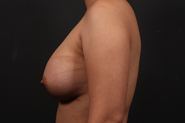 Breast Augmentation