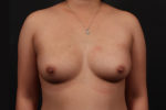 Breast Augmentation