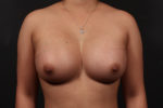 Breast Augmentation