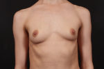 Breast Augmentation