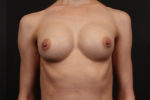 Breast Augmentation