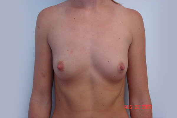 Breast Augmentation