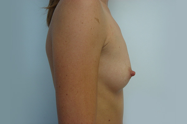 Breast Augmentation