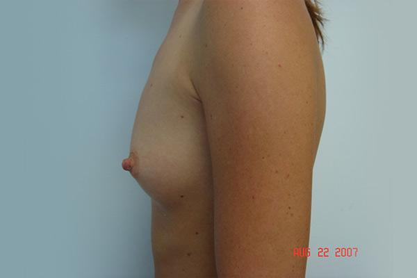 Breast Augmentation