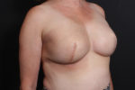 Breast Reconstruction