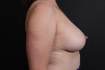 Breast Reconstruction