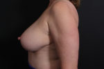 Breast Reconstruction