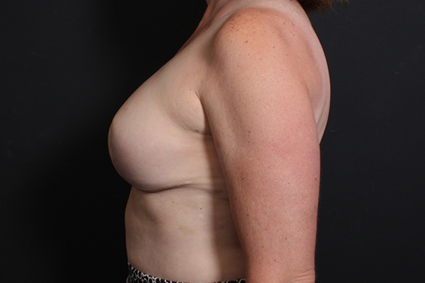 Breast Reconstruction