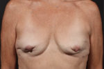 Breast Reconstruction