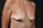 Breast Reconstruction