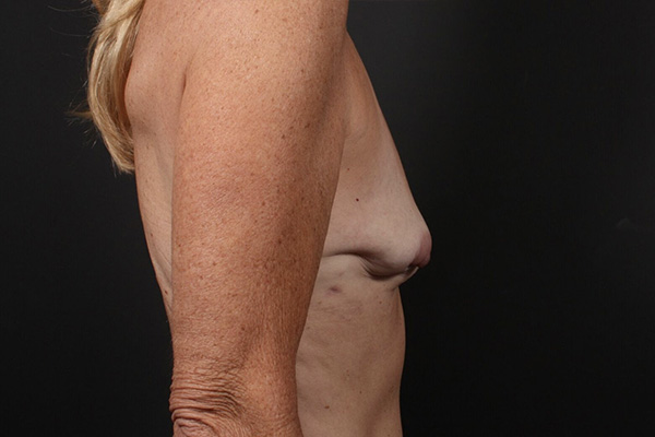 Breast Reconstruction