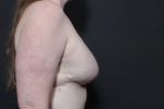 Breast Reconstruction