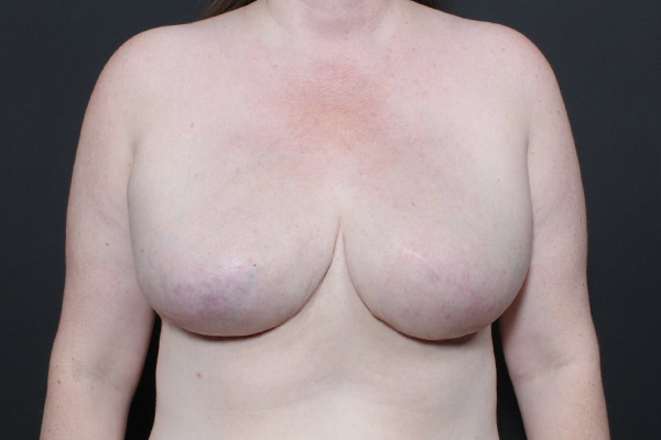 Breast Reconstruction