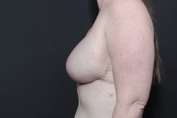 Breast Reconstruction