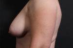 Breast Reconstruction