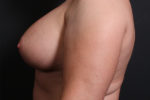 Breast Reconstruction