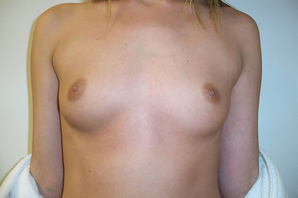 Breast Augmentation