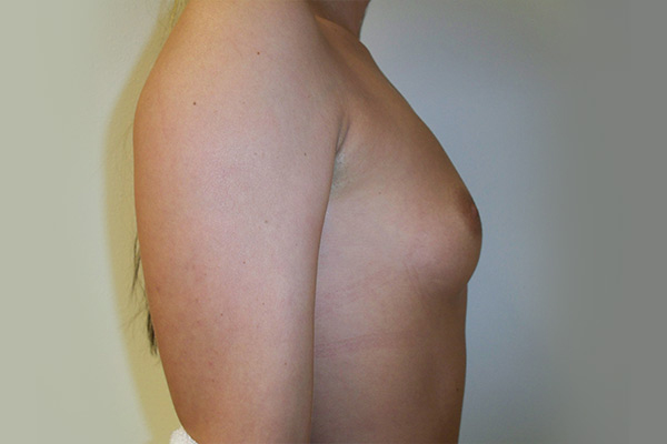 Breast Augmentation