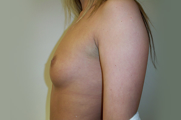 Breast Augmentation