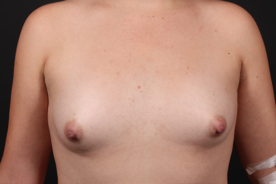 Breast Augmentation