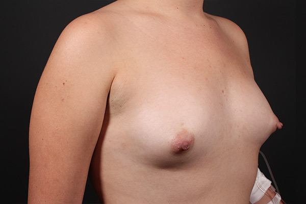 Breast Augmentation