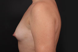 Breast Augmentation