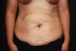 Tummy Tuck