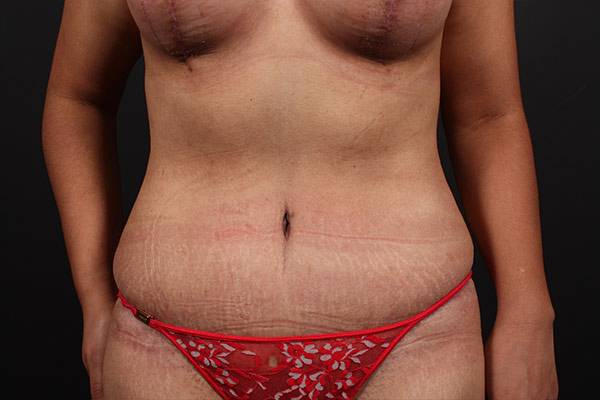 Tummy Tuck