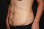 Tummy Tuck