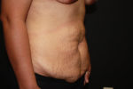 Tummy Tuck