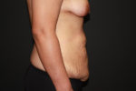 Tummy Tuck