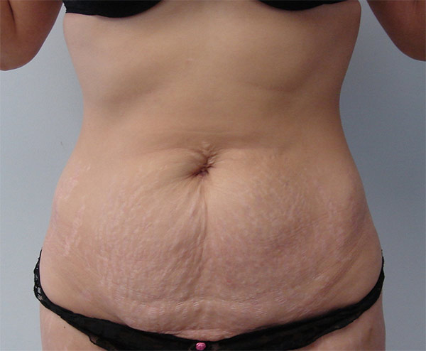 Tummy Tuck