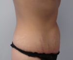 Tummy Tuck