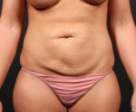 Tummy Tuck