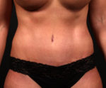 Tummy Tuck