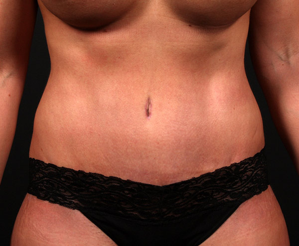 Tummy Tuck