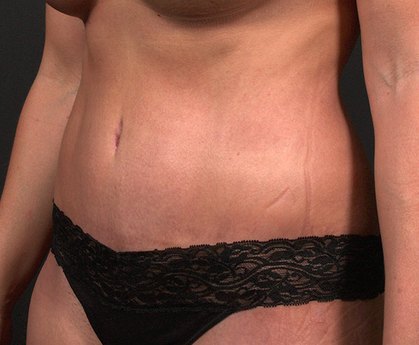 Tummy Tuck