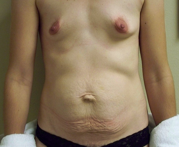 Tummy Tuck