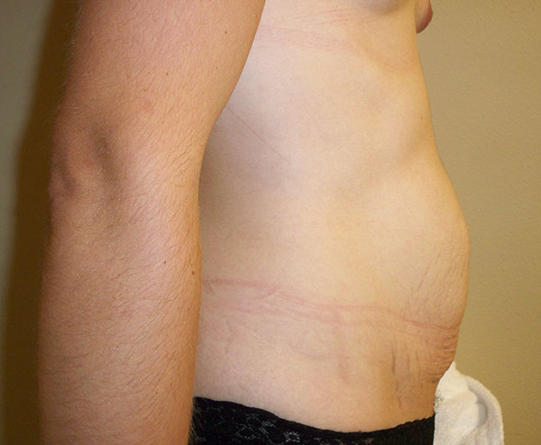 Tummy Tuck