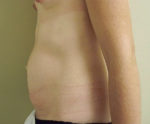 Tummy Tuck