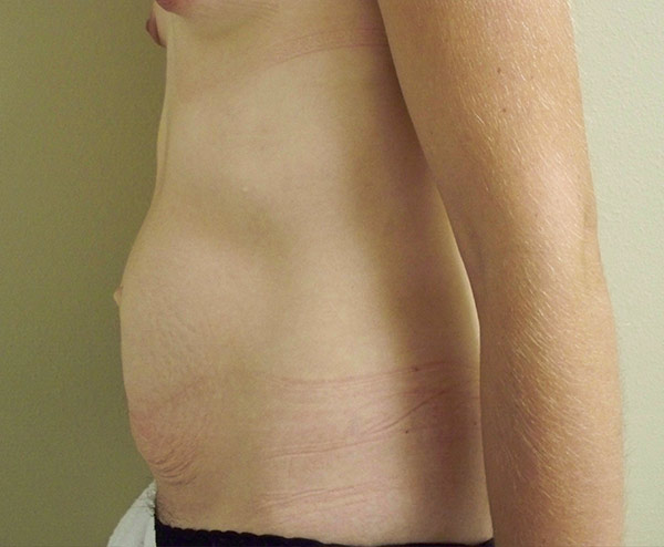 Tummy Tuck