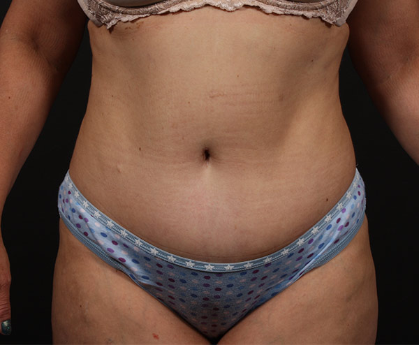 Tummy Tuck