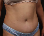 Tummy Tuck