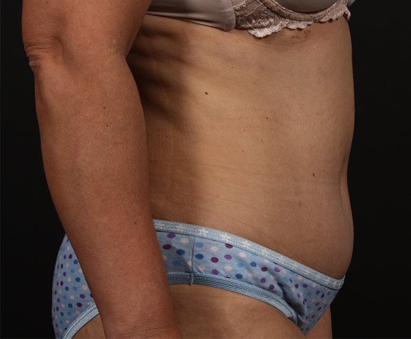 Tummy Tuck