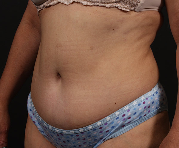 Tummy Tuck