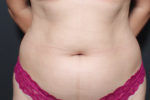 Liposuction