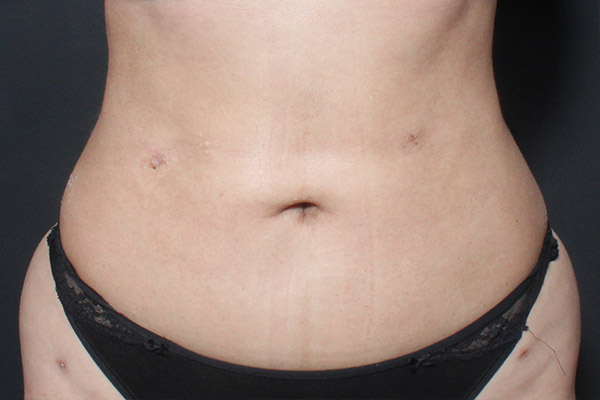 Liposuction