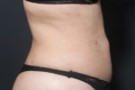 Liposuction