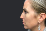 Rhinoplasty